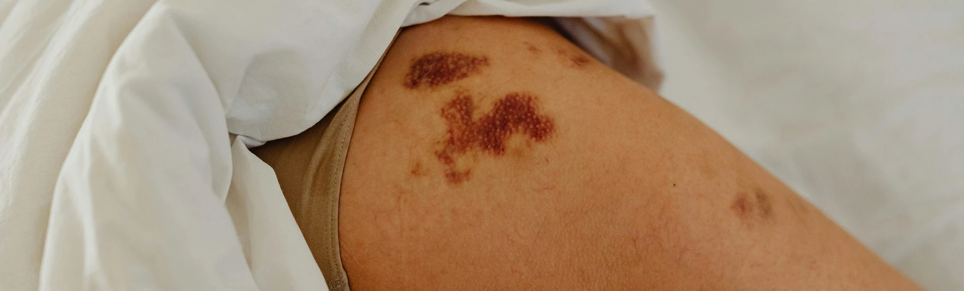 Dostępne bez recepty maści i emolienty łagodzący objawy liszaja płaskiego znajdziesz na Centralna.pl