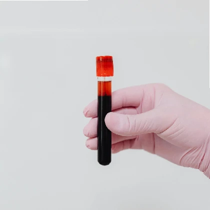 Hemochromatoza – objawy, diagnostyka, leczenie