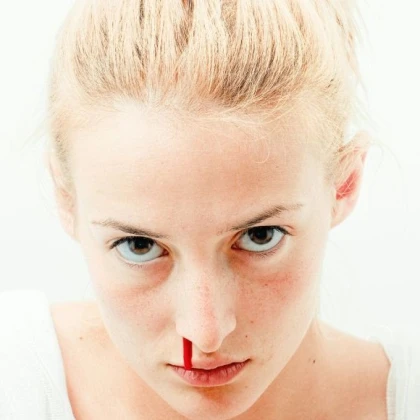 Krew z nosa – przyczyny, pierwsza pomoc i profilaktyka Krew z nosa – przyczyny, pierwsza pomoc i profilaktyka