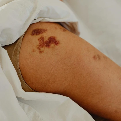 Liszaj płaski - przyczyny, objawy i sposoby leczenia