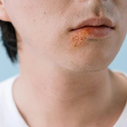 Opryszczka. Przyczyny zimna na ustach i leczenie opryszczki wargowej Opryszczka. Przyczyny zimna na ustach i leczenie opryszczki wargowej