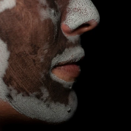 Przebarwienia na twarzy – przyczyny, leczenie i sposoby zapobiegania Przebarwienia na twarzy – przyczyny, leczenie i sposoby zapobiegania