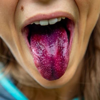 Szkarlatyna – przyczyny, objawy i sposoby leczenia