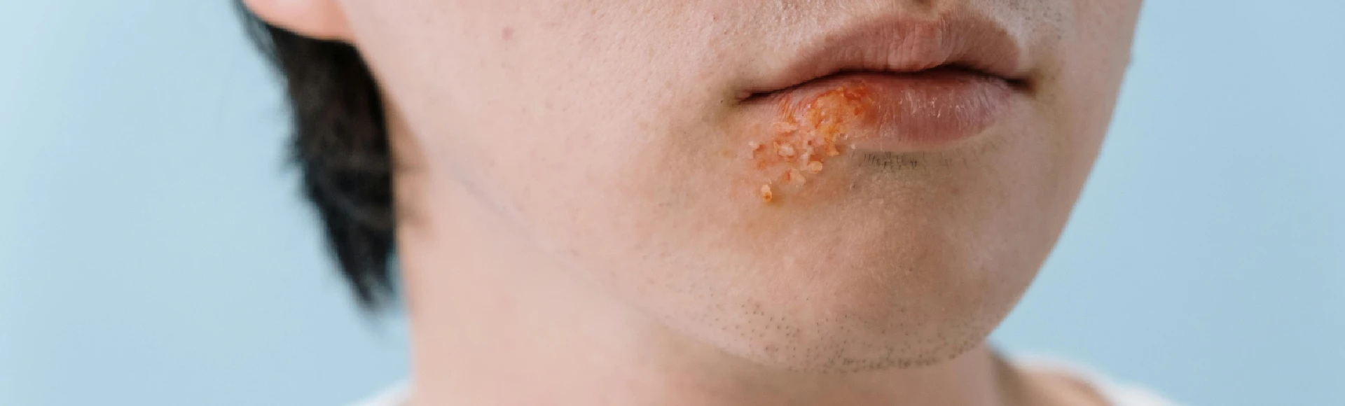 Świąd w okolicach warg oraz bolesne pęcherzyki na ustach to typowe objawy opryszczki. Dostępne bez recepty leki przeciwwirusowe, plasterki i maści na opryszczkę znajdziesz w Aptece Centralnej.